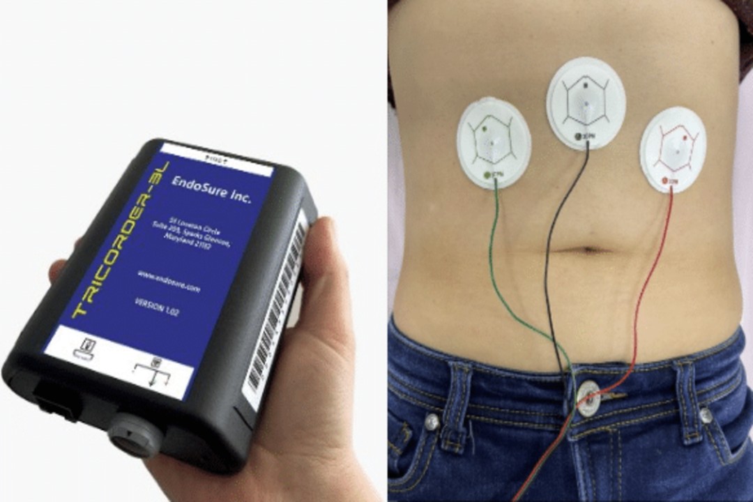 A collage showing the EndoSure test on the left and sensors hooked up to a patient's abdomen on the right.